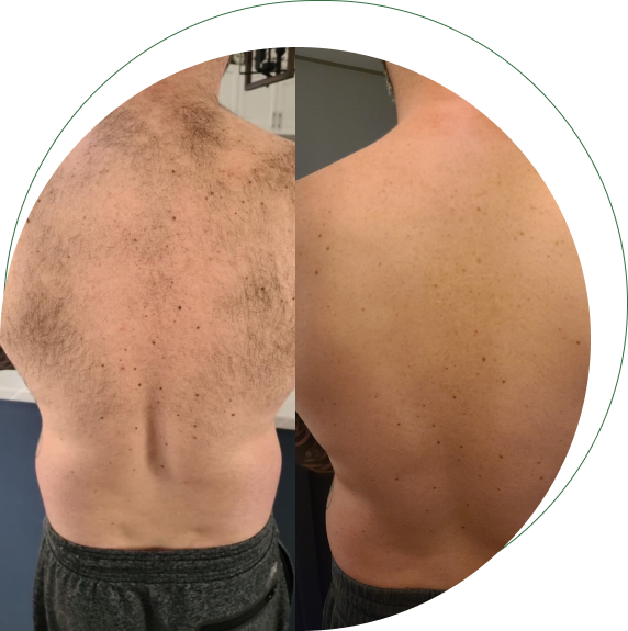 The Laser Hair Removal service in St. Catharines offers a safe and effective solution to eliminate unwanted hair