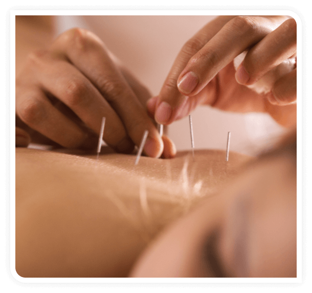 Embark on a journey of healing with our Acupuncture services in North York, Toronto
