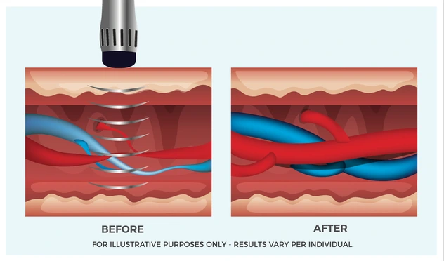 RevitalWave treats the cause of Erectyle Dysfunction with permanent solutions in Long Island, NY