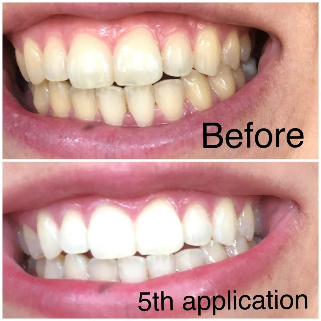Discover before and after results of Teeth Whitening after the 5th Application at RevitalWave in Long Island