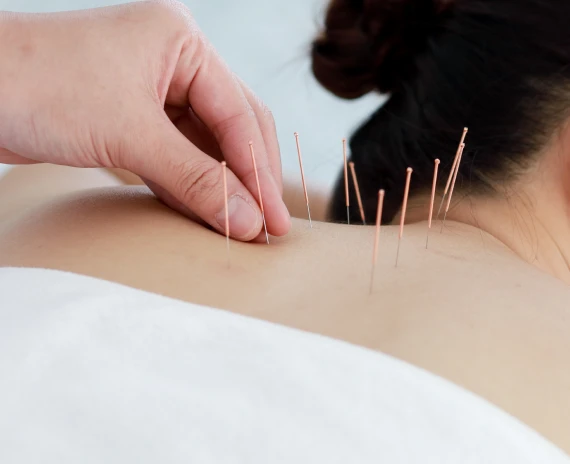 Experience holistic healing with Acupuncture Treatment at the Acupuncture & Healing Center in Manassas