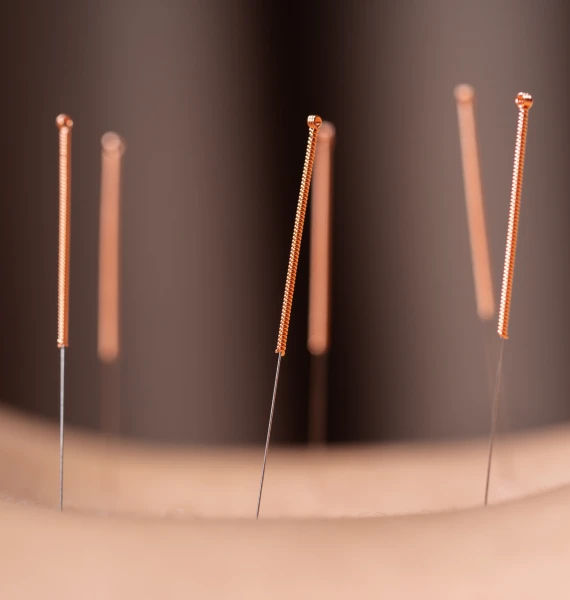 Using Acupuncture, we offer specialized treatment for various Acute and Chronic conditions