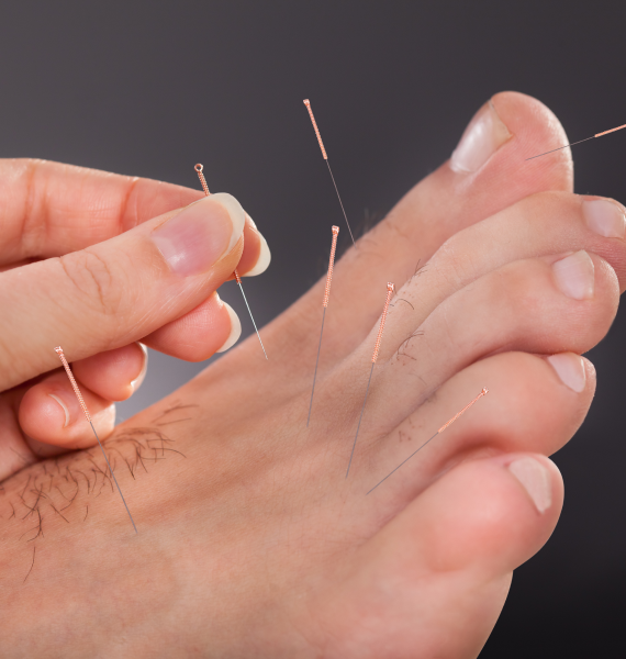 Rediscover balance with Acupuncture services in Clifton, provided by the Acupuncture & Healing Center