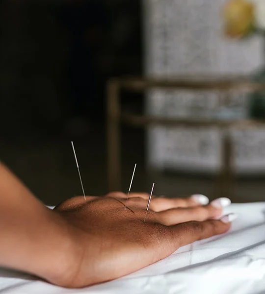 The Acupuncture & Healing Centre in Burke can improve your health by providing Acupuncture services