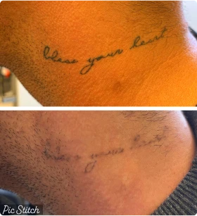 At Blix Clinical Aesthetics & Laser, we excel in achieving impeccable Tattoo Removal results in Seattle