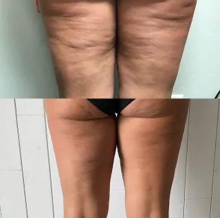Cellulite-thigh-tx-(1) 1.webp