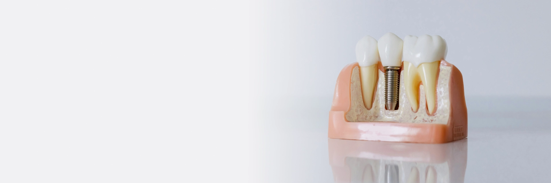 Dental Implants North York