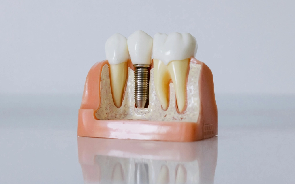 Dental Implants North York
