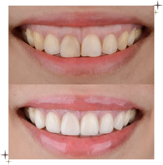 Composite Veneers Toronto