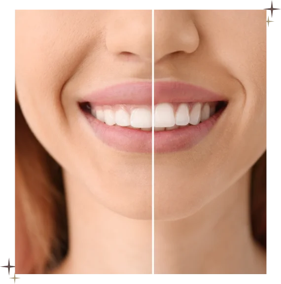 Composite Veneers Toronto