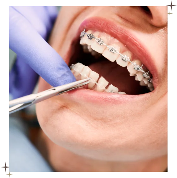 Clear Dental Aligners​