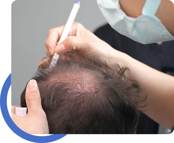 Fue Hair Transplant San Jose