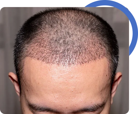 Fue Hair Transplant San Jose