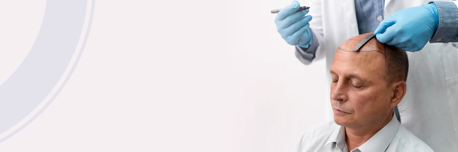 Fut Hair Transplant San Jose