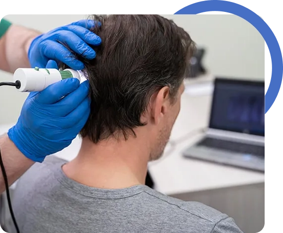 Fut Hair Transplant San Jose