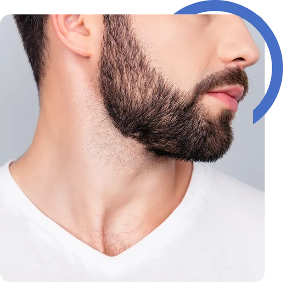 Beard Transplant Bay Area