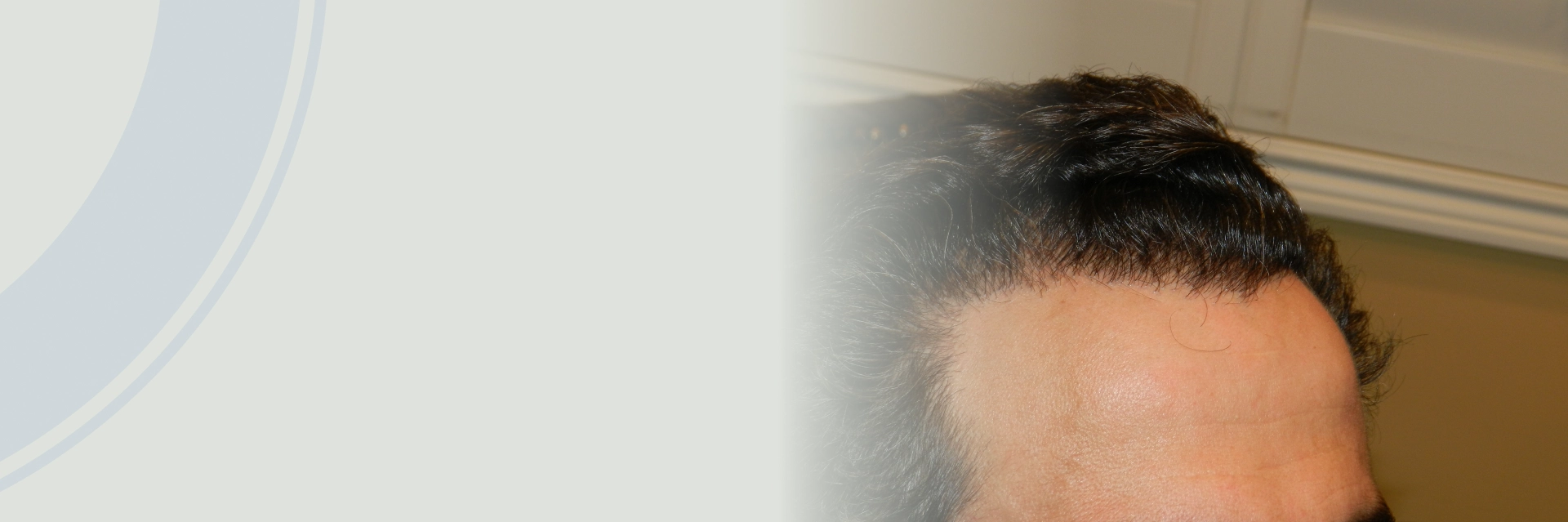 Hair Transplant For Men