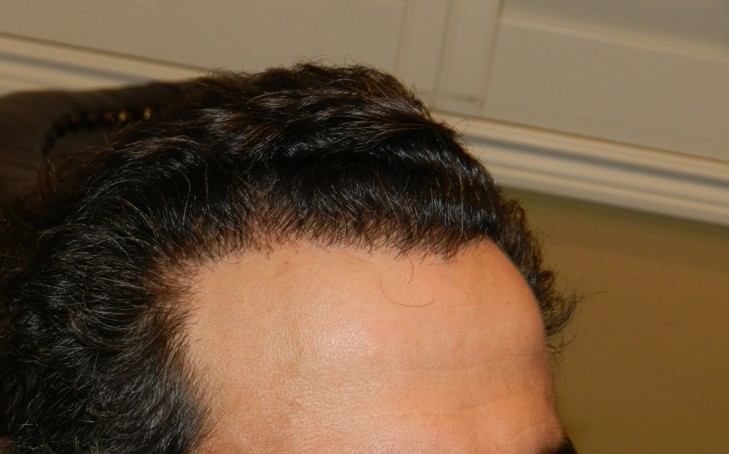 Hair Transplant For Men
