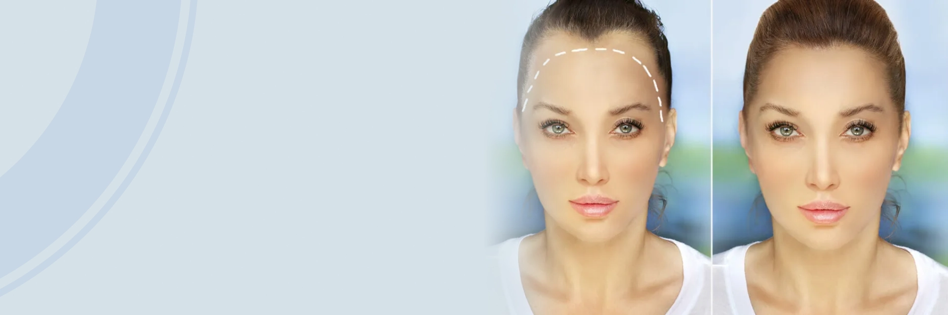 Hair Restoration For Females