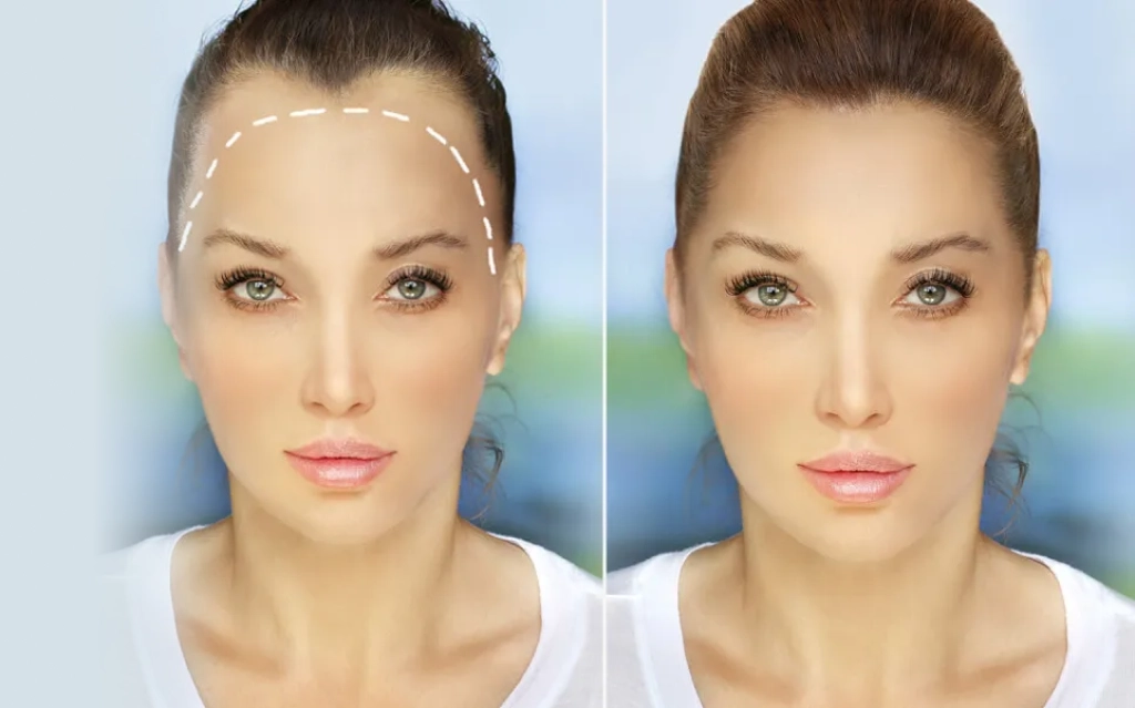 Hair Restoration For Females

