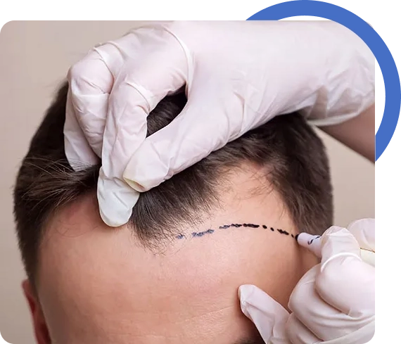 Hair Balding Treatment
