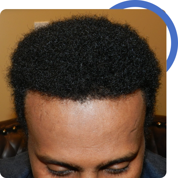 African American Hair Transplant San Francisco