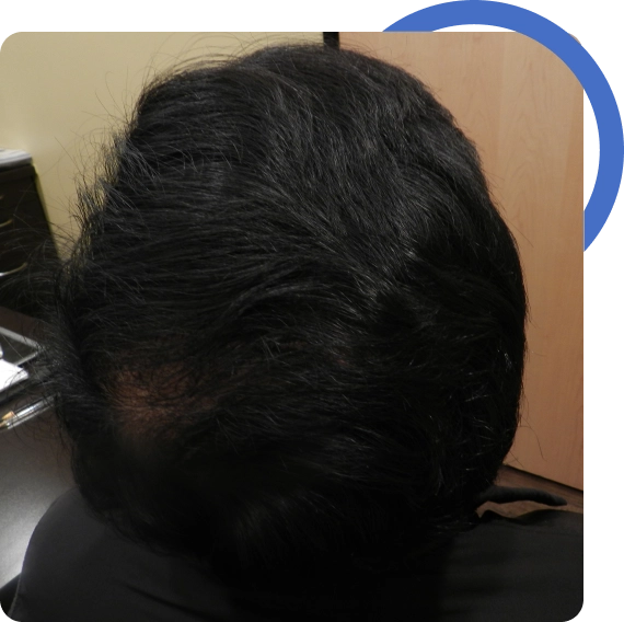 Vertex Hair Transplant