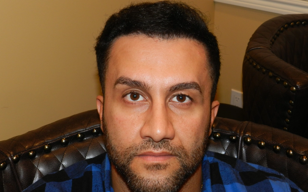 Hairline Restoration Surgery

