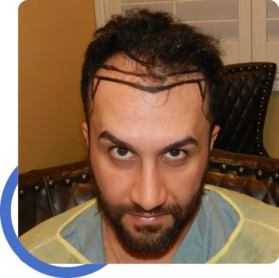 Hairline Transplant Surgery​