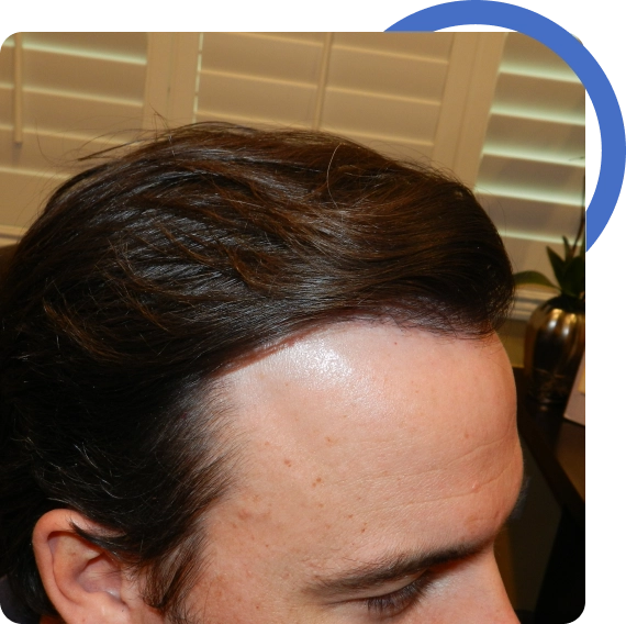 Hairline Transplant Surgery​