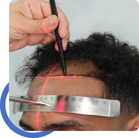 Wavy Hair Transplant