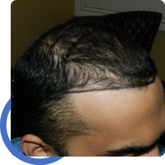 Hair Transplant San Jose