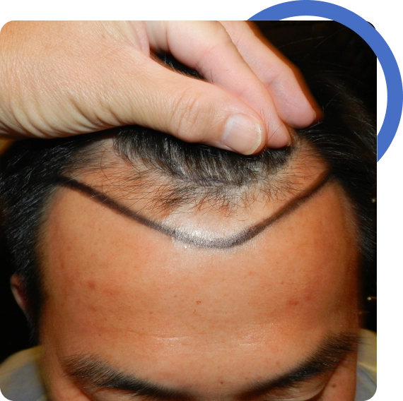 Hair Transplant San Jose