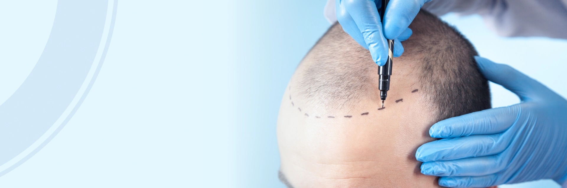 Fue Vs Fut Hair Transplant​