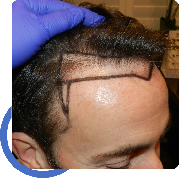 Fue Vs Fut Hair Restoration