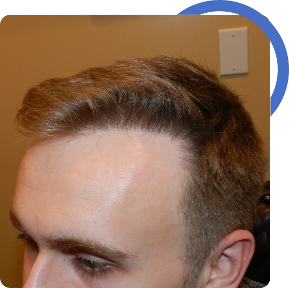 Fue Vs Fut Hair Transplant​