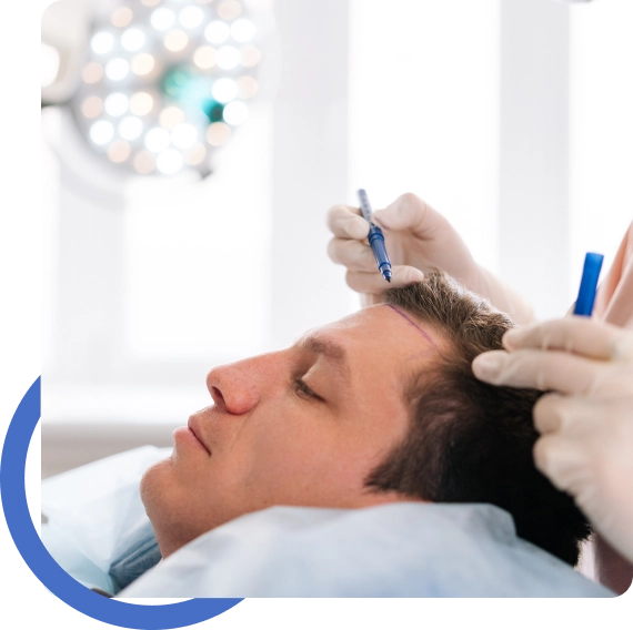 Hair Restoration San Jose