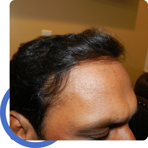 Hair Restoration Fremont