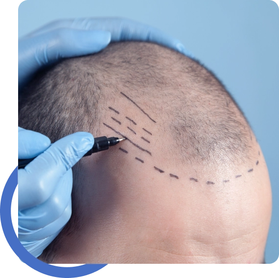 Hair Transplant New York