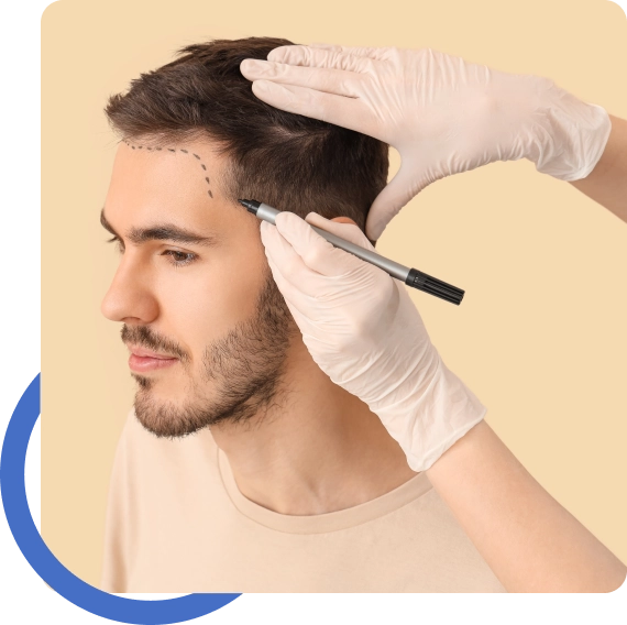 Hair Transplant Palo Alto