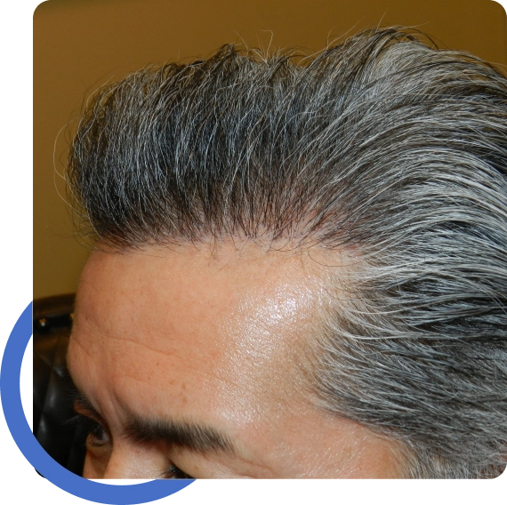 Hair Transplant Pleasanton