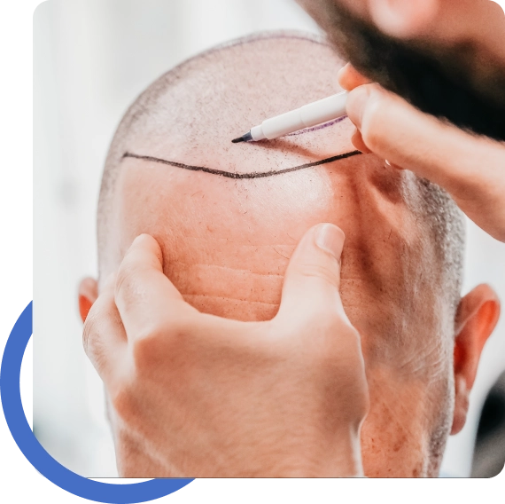 Hair Transplant San Diego