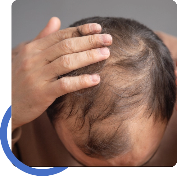 Hair Transplant Fresno