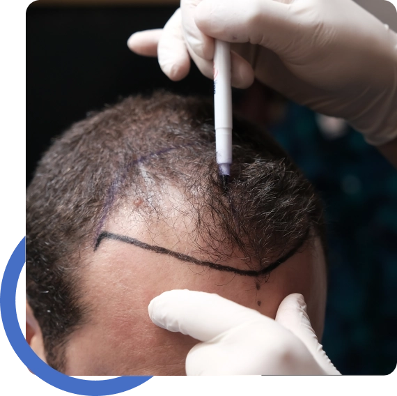 Hair Transplant Santa Rosa