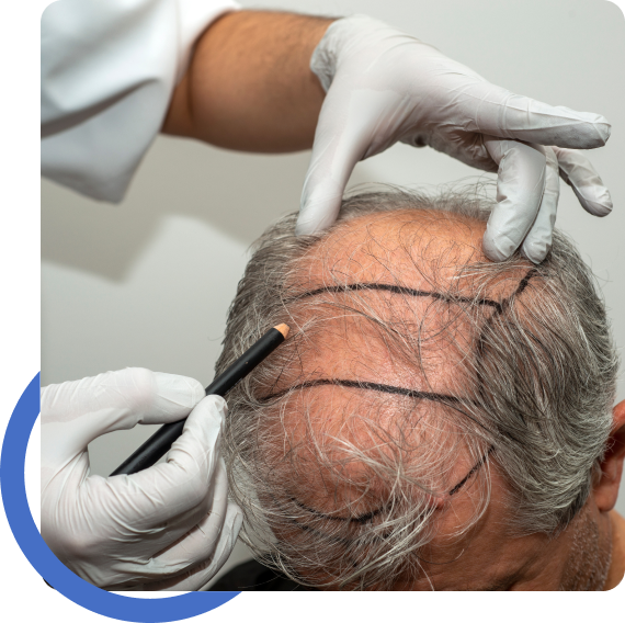 Hair Restoration Houston