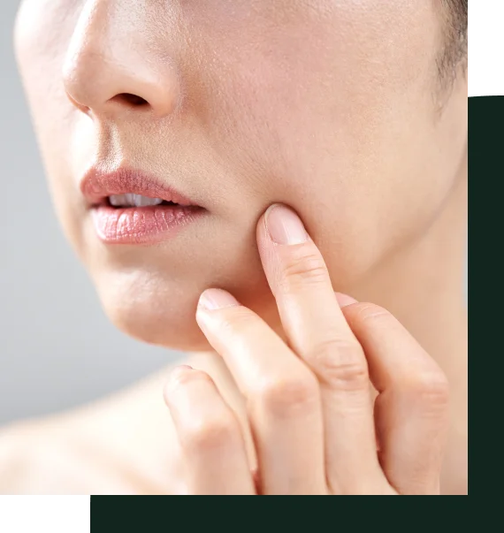 Nasolabial Fold Softening