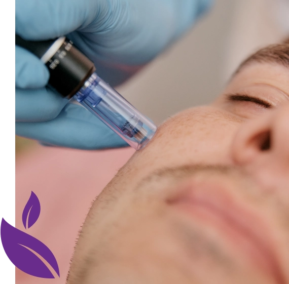 Microneedling Therapy