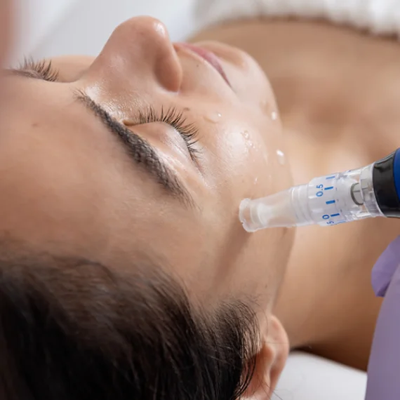 PRP Treatment SkinPen Microneedling