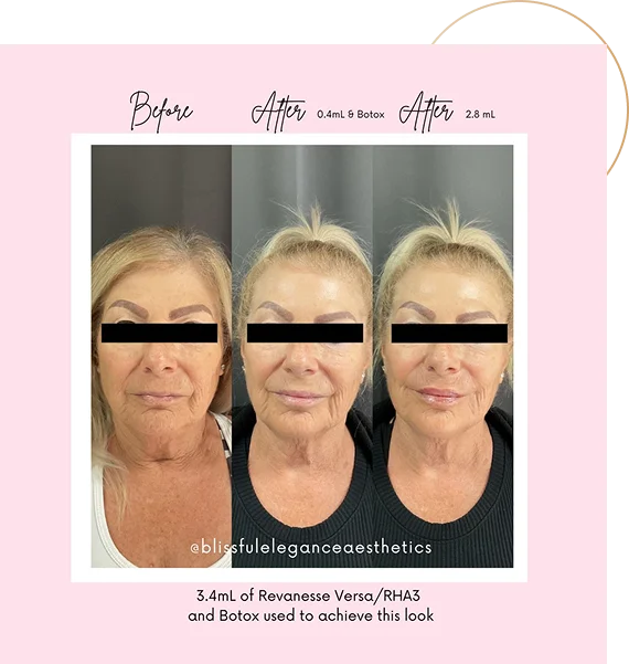 Why Choose Neuromodulators for Wrinkle Relief