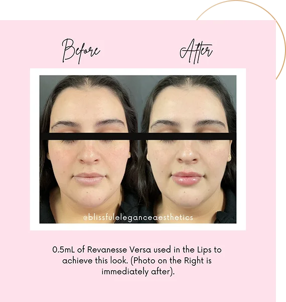 Dermal Fillers for Facial Rejuvenation